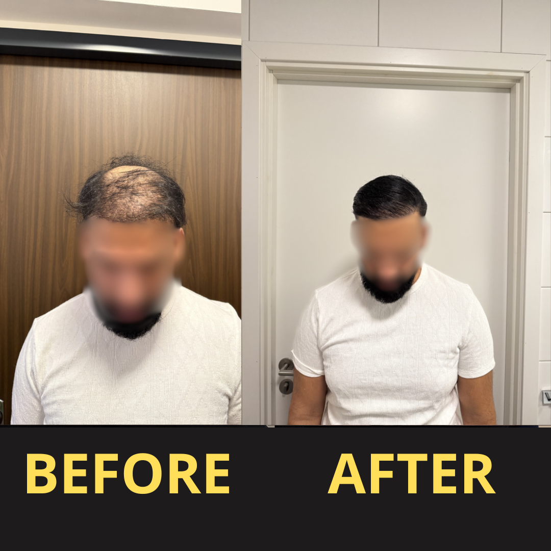 HairGent Siyah Saç Kapatıcı – Suya Dayanıklı, 3–7 Gün Etkili